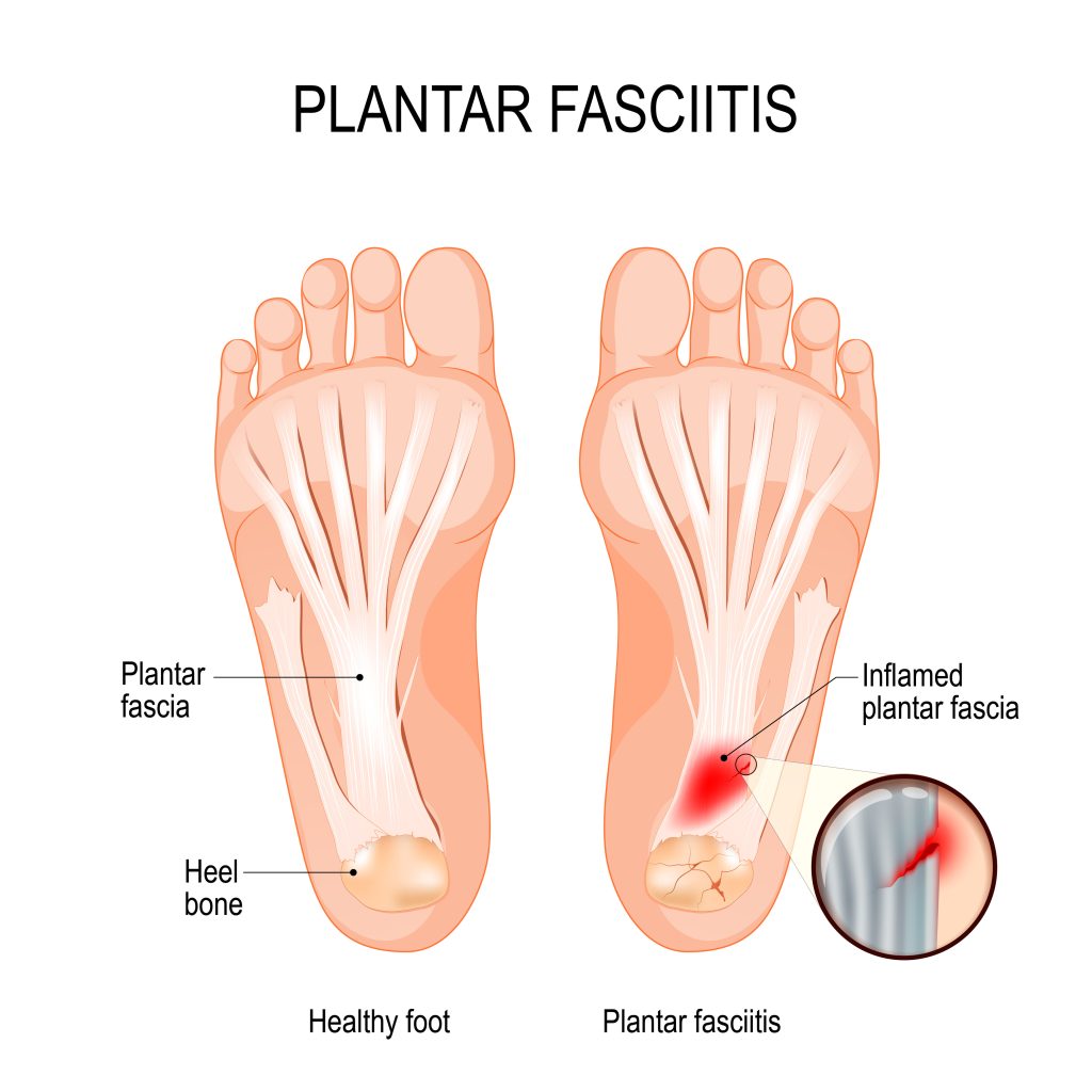 Plantar Fasciitis Treatment