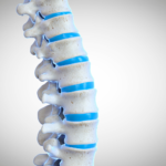 Revolutionizing Spinal Treatment: Kyphoplasty Through the Lens of Orthopedic Expertise