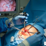 rotator cuff surgery