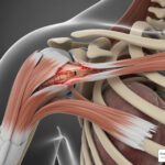 torn rotator cuff