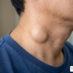 hard knot on right side of neck