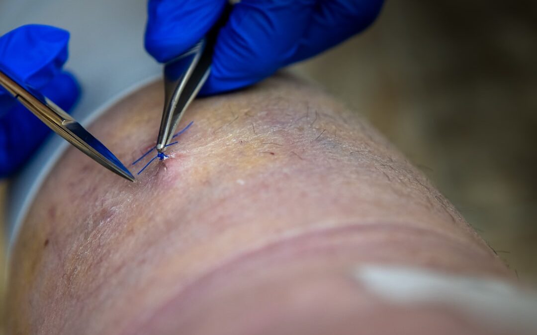 thigh fasciotomy