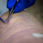 thigh fasciotomy