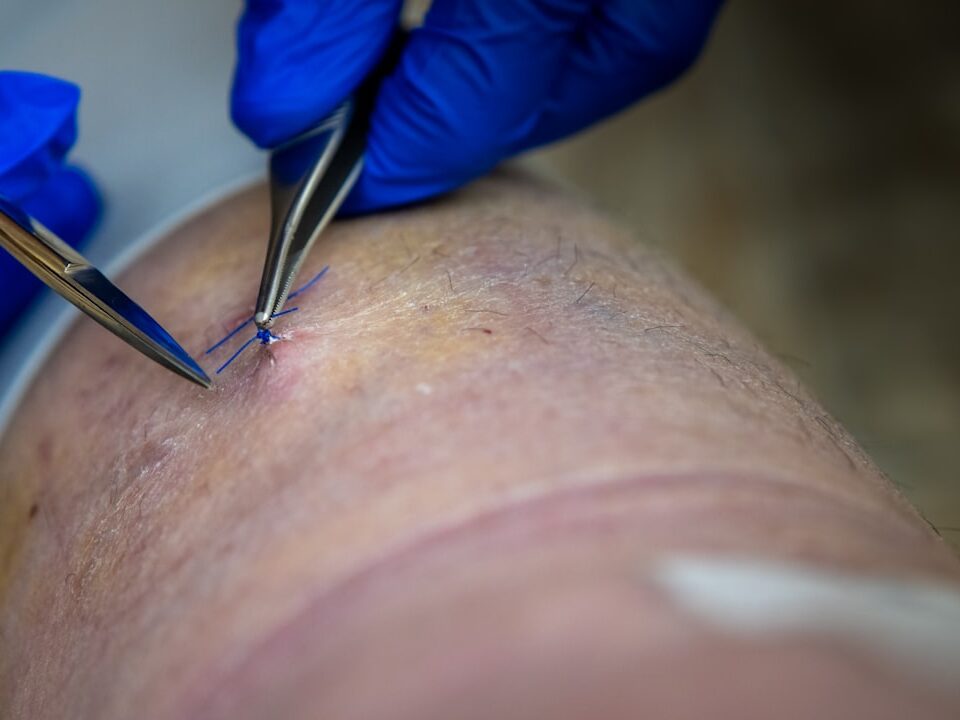 thigh fasciotomy