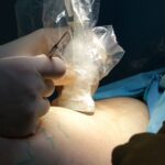 fasciotomy